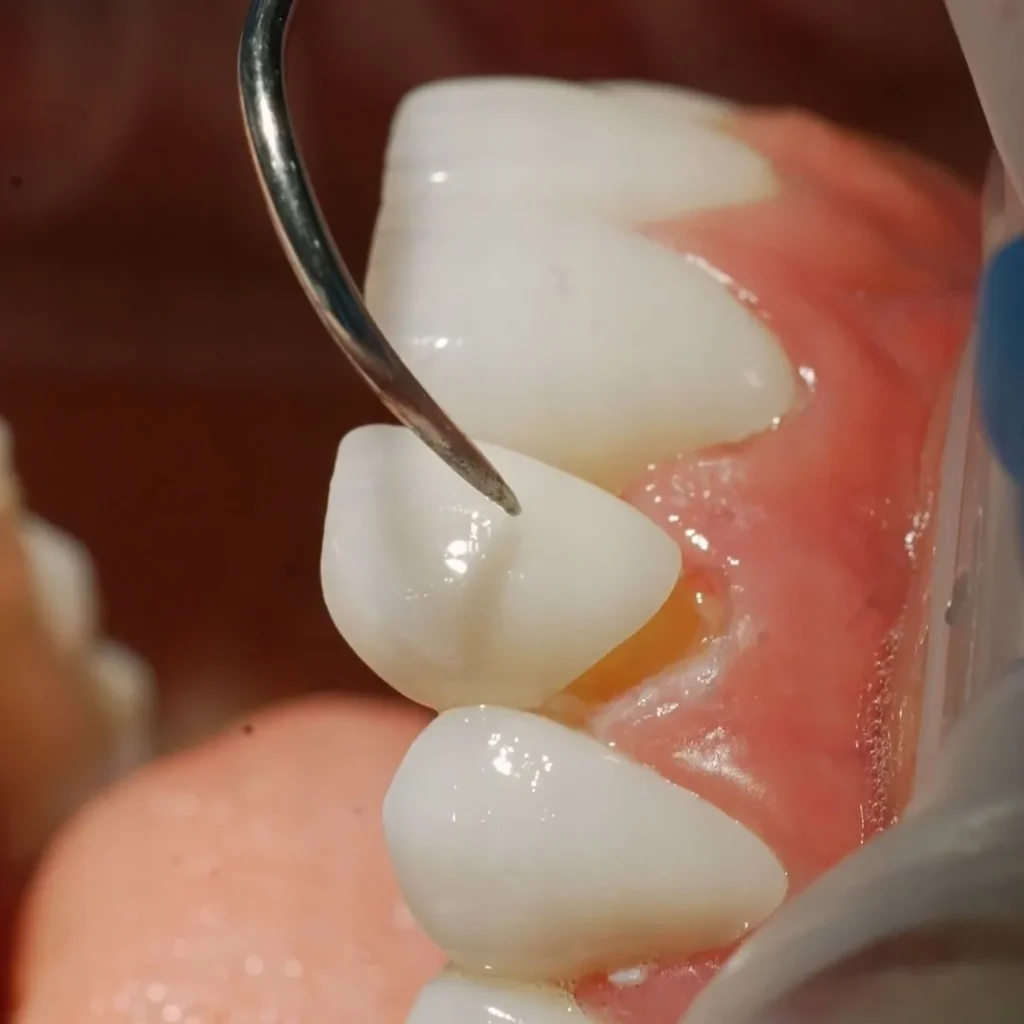 Dental Veneers in Dubai Deira