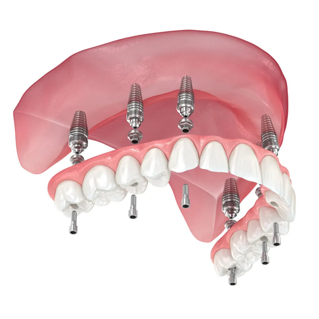 All-on-6® Dental Implants