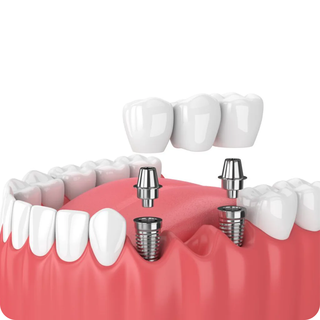 Multiple Teeth Implants (Implant-Supported Bridge)