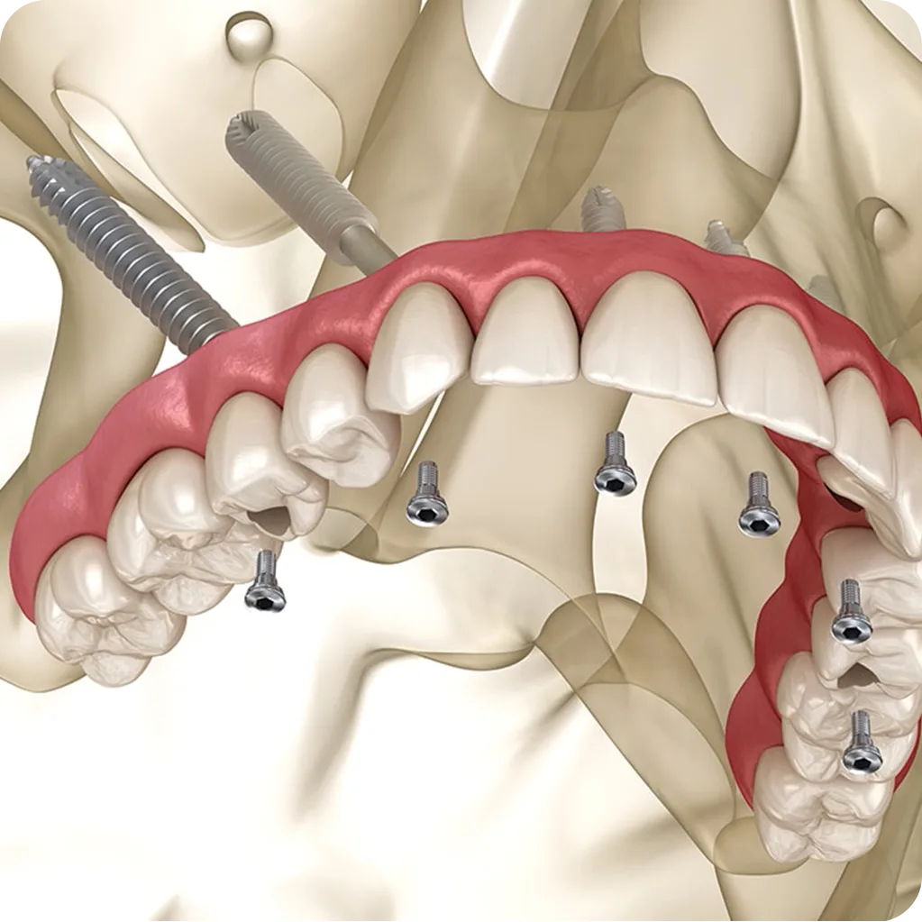 Zygomatic Implants (For Severe Bone Loss)