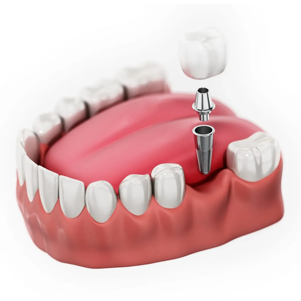 single-tooth-dental-implants