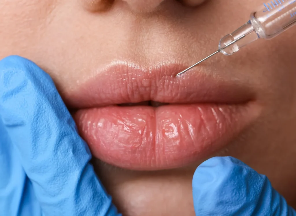 How long does lip filler take to wear off