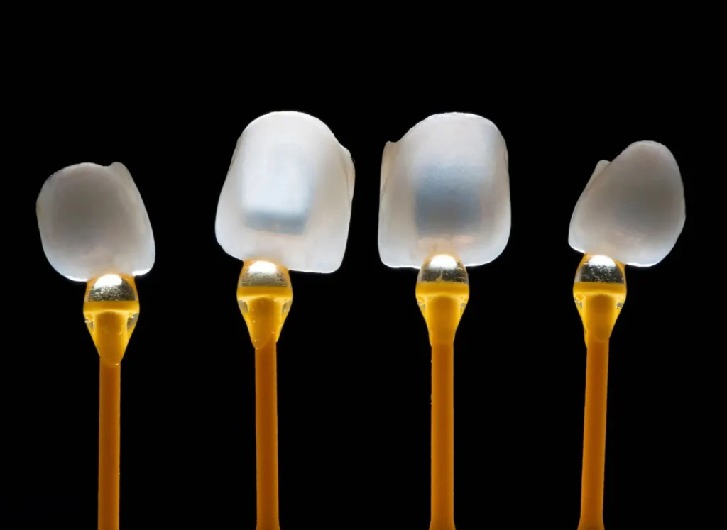 can veneers correct an overbite