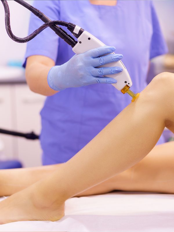 laser hair removal