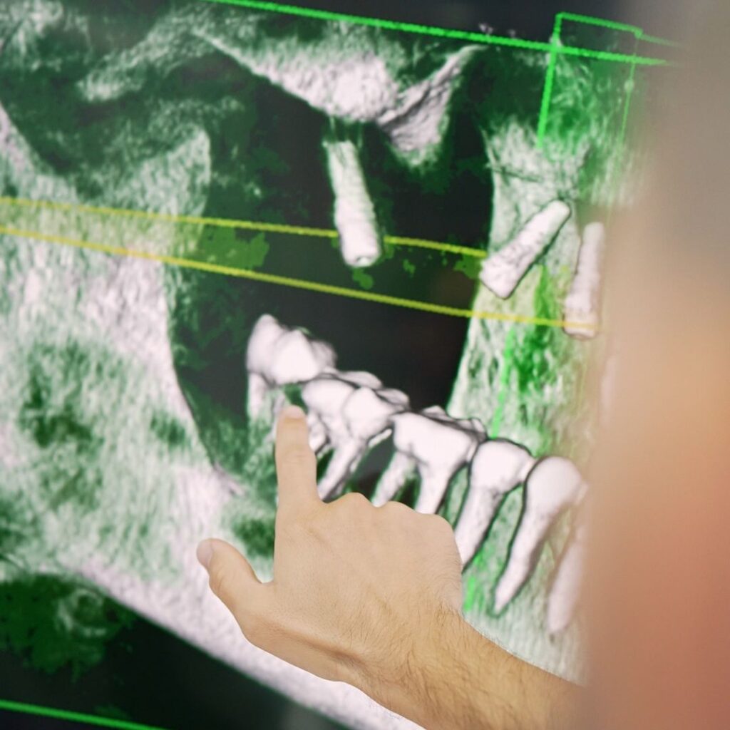 Dental Implants in Dubai Deira