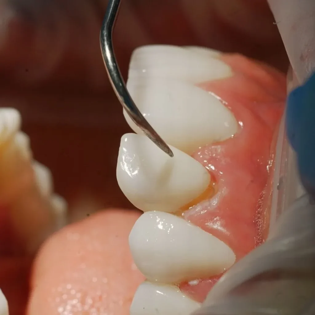 Dental Veneers in Dubai Deira