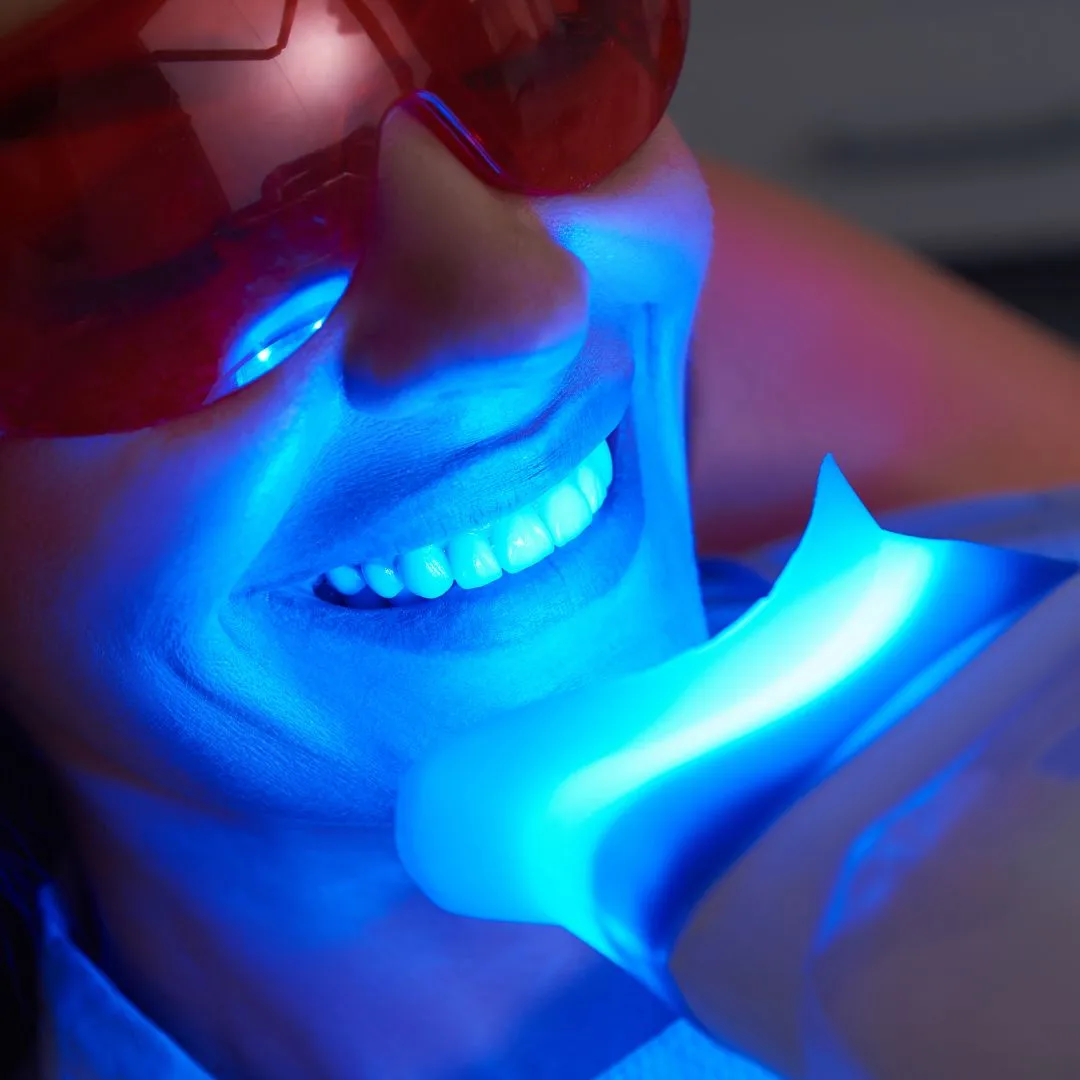 Teeth Whitening 160 teeth whitening in Dubai Deira